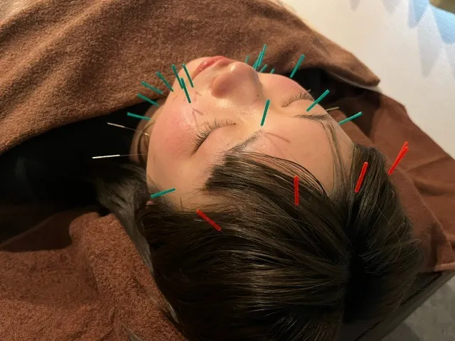 鍼灸施術の様子